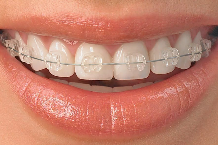 Invisible Braces Treatment